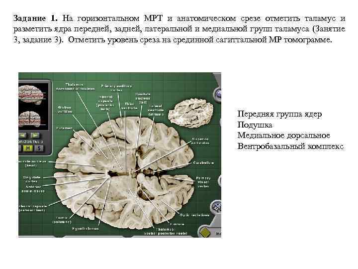 Задание 1. На горизонтальном МРТ и анатомическом срезе отметить таламус и разметить ядра передней,