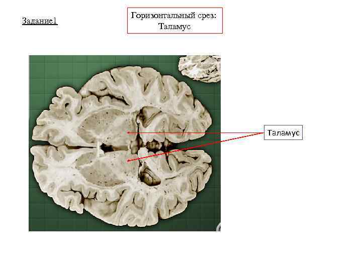 Задание 1 Горизонтальный срез: Таламус 