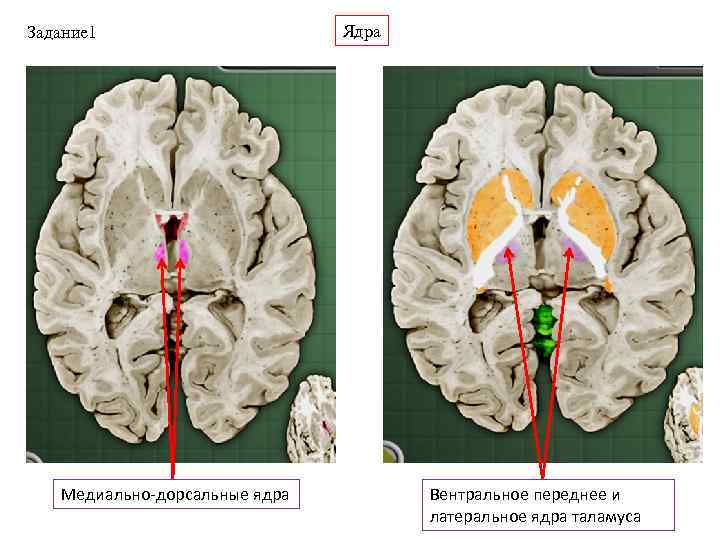 Задание 1 Медиально-дорсальные ядра Ядра Вентральное переднее и латеральное ядра таламуса 