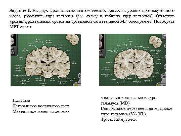 Задание 2. На двух фронтальных анатомических срезах на уровне промежуточного мозга, разметить ядра таламуса