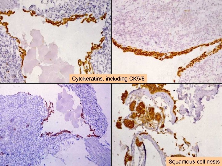 Cytokeratins, including CK 5/6 Squamous cell nests 