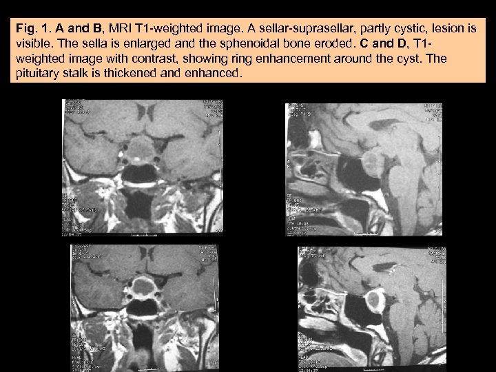 Fig. 1. A and B, MRI T 1 -weighted image. A sellar-suprasellar, partly cystic,