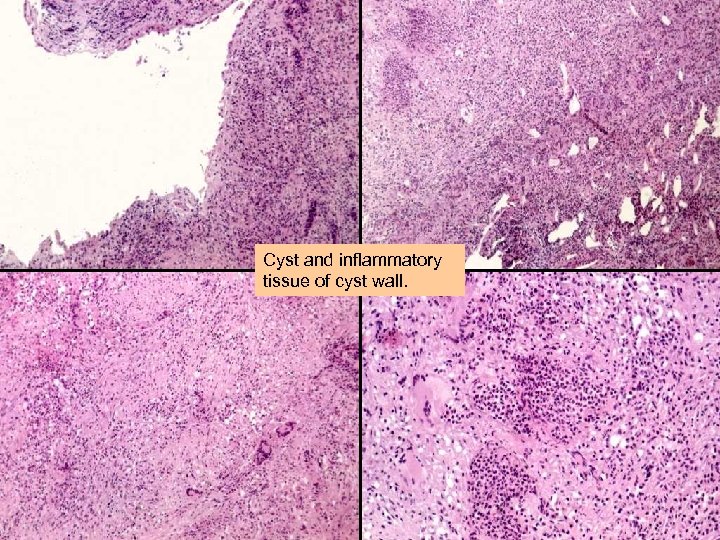 Cyst and inflammatory tissue of cyst wall. 