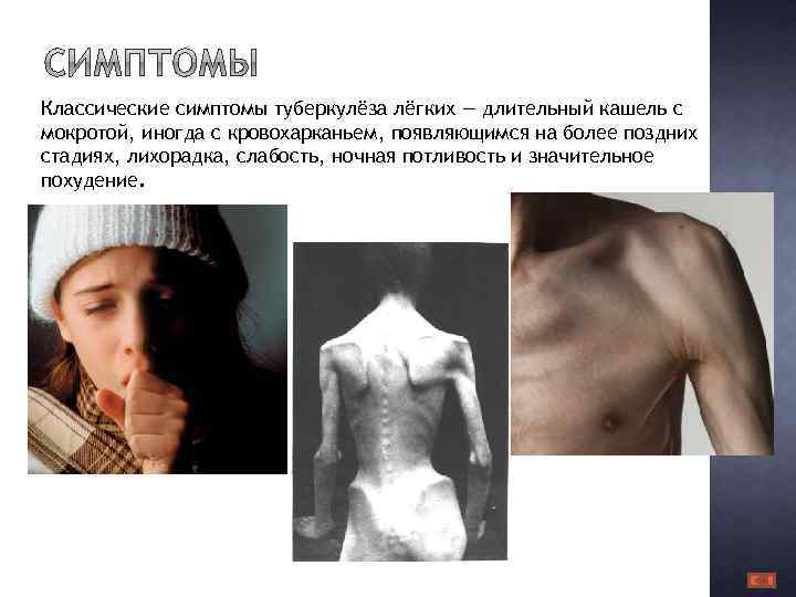 Классические симптомы туберкулёза лёгких — длительный кашель с мокротой, иногда с кровохарканьем, появляющимся на