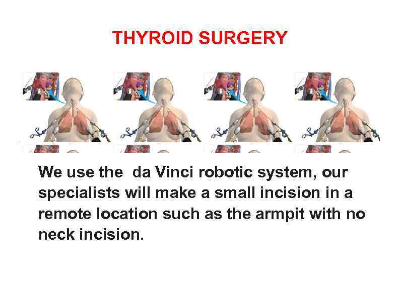 THYROID SURGERY We use the da Vinci robotic system, our specialists will make a