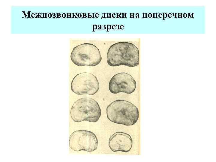 Межпозвонковые диски на поперечном разрезе 