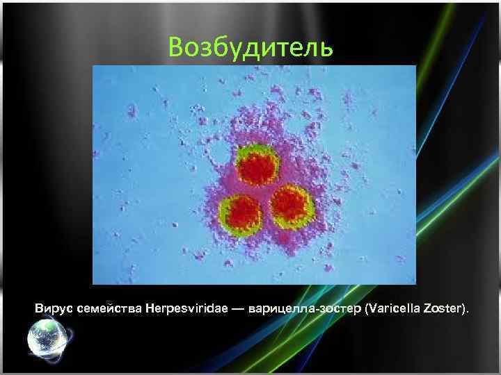 Возбудитель Вирус семейства Herpesviridae — варицелла-зостер (Varicella Zoster). 