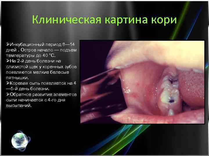 Клиническая картина кори ØИнкубационный период 8— 14 дней. Острое начало — подъем температуры до