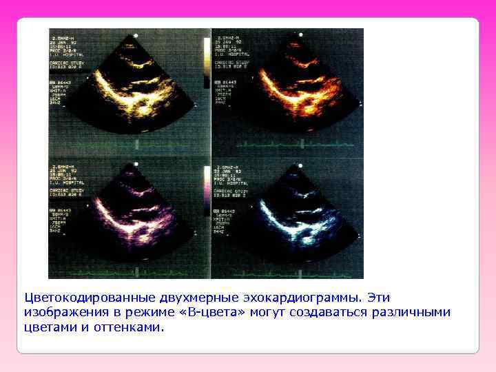 Цветокодированные двухмерные эхокардиограммы. Эти изображения в режиме «B-цвета» могут создаваться различными цветами и оттенками.