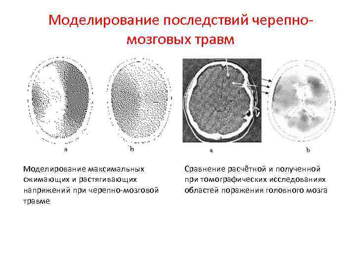 Моделирование последствий черепномозговых травм Моделирование максимальных сжимающих и растягивающих напряжений при черепно-мозговой травме Сравнение