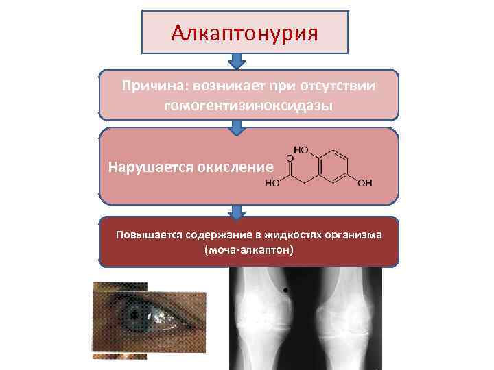 Алкаптонурия Причина: возникает при отсутствии гомогентизиноксидазы Нарушается окисление Повышается содержание в жидкостях организма (моча-алкаптон)