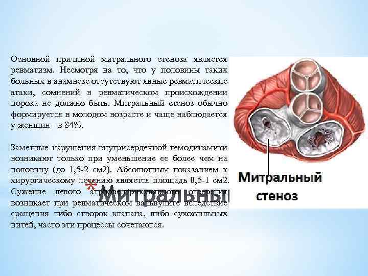 Основной причиной митрального стеноза является ревматизм. Несмотря на то, что у половины таких больных
