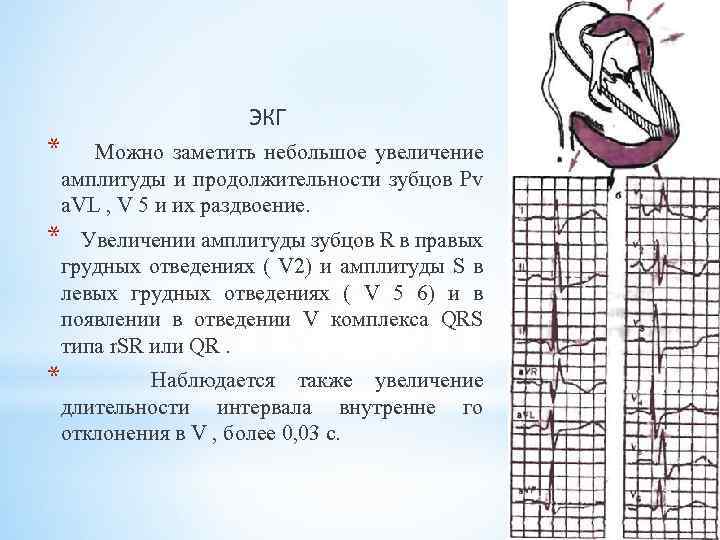 Увеличение амплитуды. Увеличение амплитуды зубца r. Раздвоение зубца r в 3 отведении. Динамика амплитуды зубца т. Увеличение амплитуды зубца r в v4.