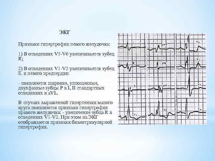ЭКГ Признаки гипертрофии левого желудочка: 1) В отведениях V 5 -V 6 увеличивается зубец
