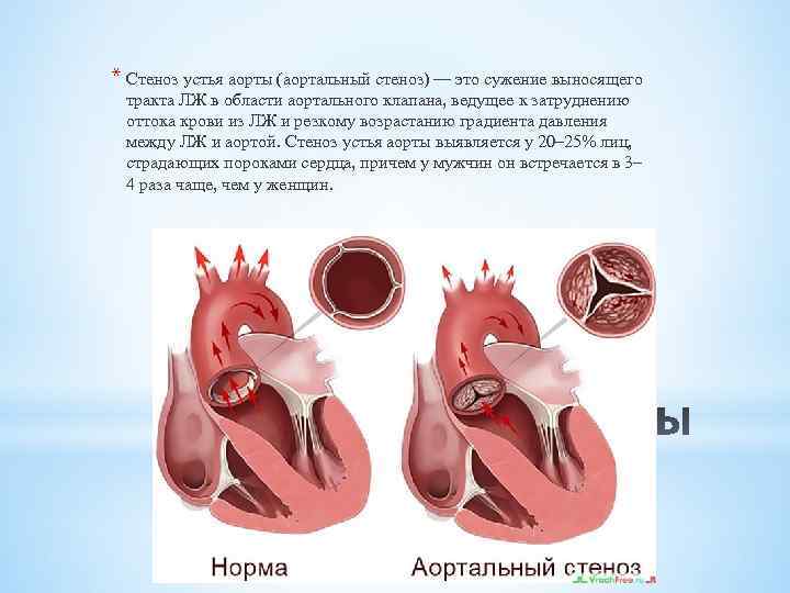 Стеноз устья аорты и аортальный стеноз. Стеноз аортального отверстия. Стеноз устья аорты препараты. Стеноз устья аорты степени.