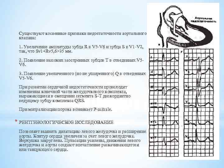 Существуют косвенные признаки недостаточности аортального клапана: 1. Увеличение амплитуды зубца R в V 5