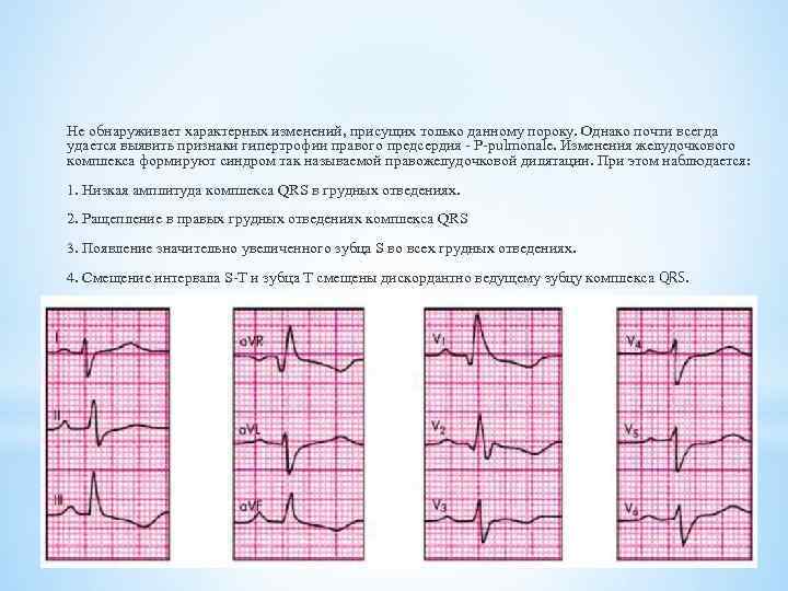 Не обнаруживает характерных изменений, присущих только данному пороку. Однако почти всегда удается выявить признаки