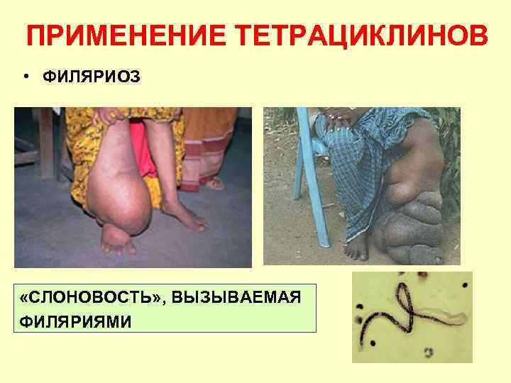 ПРИМЕНЕНИЕ ТЕТРАЦИКЛИНОВ • ФИЛЯРИОЗ «СЛОНОВОСТЬ» , ВЫЗЫВАЕМАЯ ФИЛЯРИЯМИ 