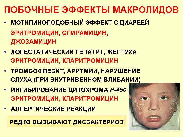 ПОБОЧНЫЕ ЭФФЕКТЫ МАКРОЛИДОВ • МОТИЛИНОПОДОБНЫЙ ЭФФЕКТ С ДИАРЕЕЙ ЭРИТРОМИЦИН, СПИРАМИЦИН, ДЖОЗАМИЦИН • ХОЛЕСТАТИЧЕСКИЙ ГЕПАТИТ,
