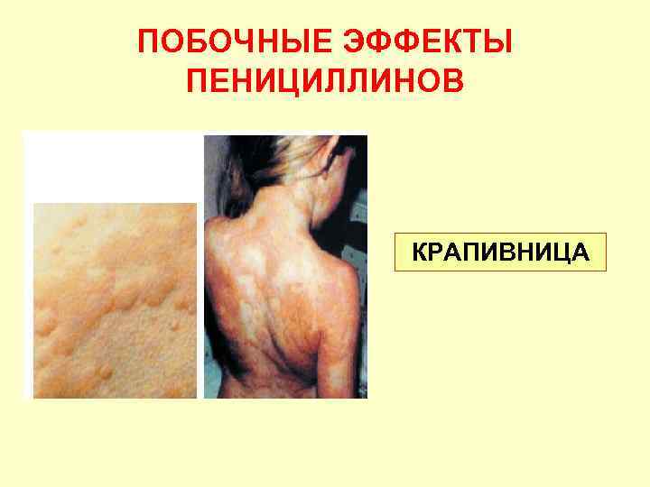 ПОБОЧНЫЕ ЭФФЕКТЫ ПЕНИЦИЛЛИНОВ КРАПИВНИЦА 