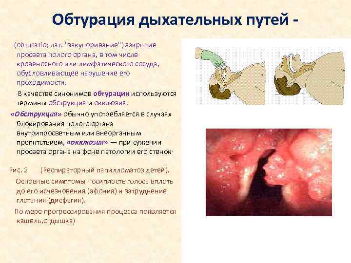 Обтурация дыхательных путей - (obturatio; лат. 