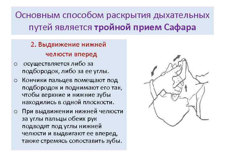 Основным способом раскрытия дыхательных путей является тройной прием Сафара 2. Выдвижение нижней челюсти вперед