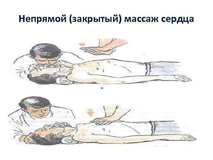 Непрямой (закрытый) массаж сердца 