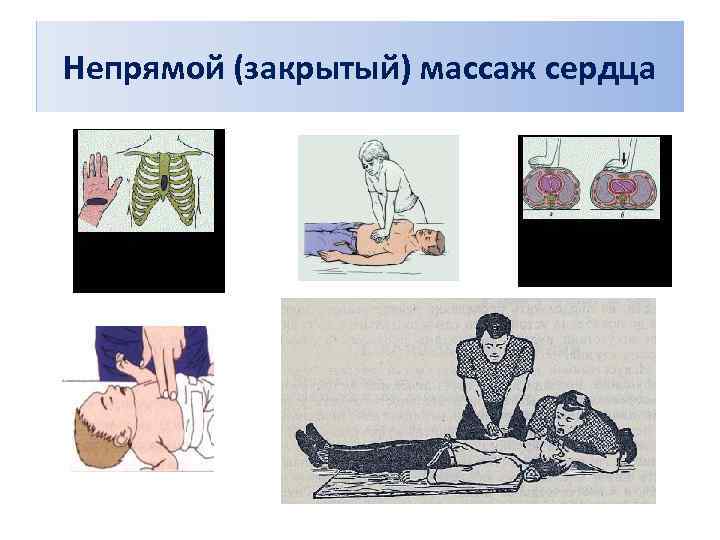 Непрямой (закрытый) массаж сердца 