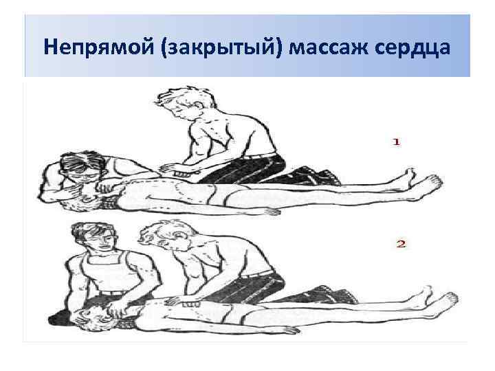 Непрямой (закрытый) массаж сердца 