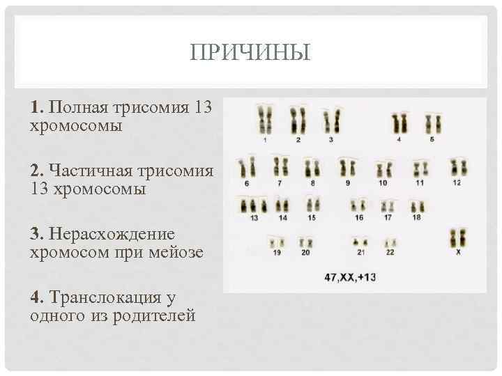 Трисомия по 23 паре