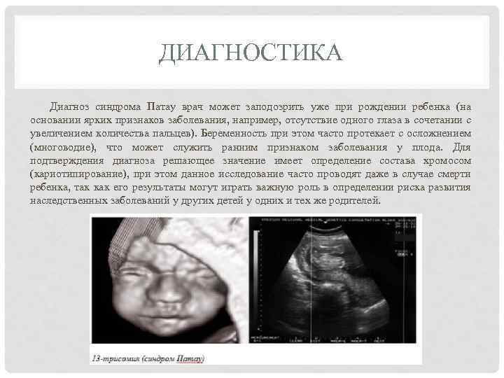 ДИАГНОСТИКА Диагноз синдрома Патау врач может заподозрить уже при рождении ребенка (на основании ярких