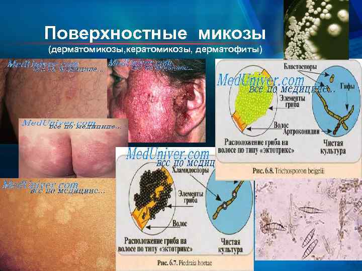 Поверхностные микозы (дерматомикозы, кератомикозы, дерматофиты) 