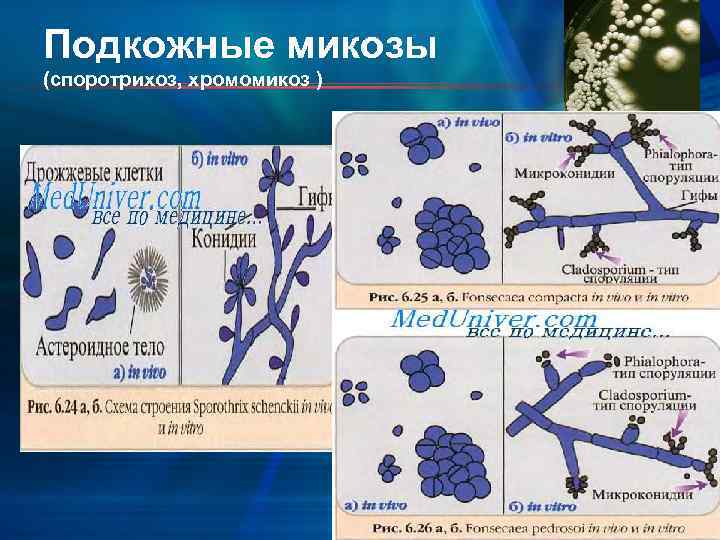 Подкожные микозы (споротрихоз, хромомикоз ) 