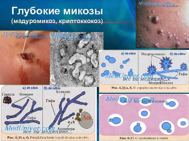 Глубокие микозы (мадуромикоз, криптоккокоз) 