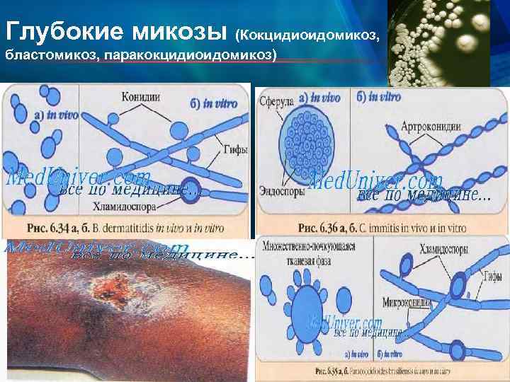 Глубокие микозы (Кокцидиоидомикоз, бластомикоз, паракокцидиоидомикоз) 