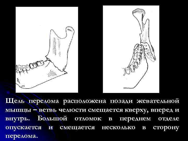 Вывих челюсти карта вызова скорой