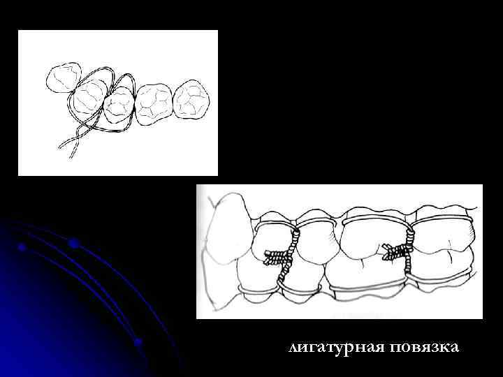 лигатурная повязка 