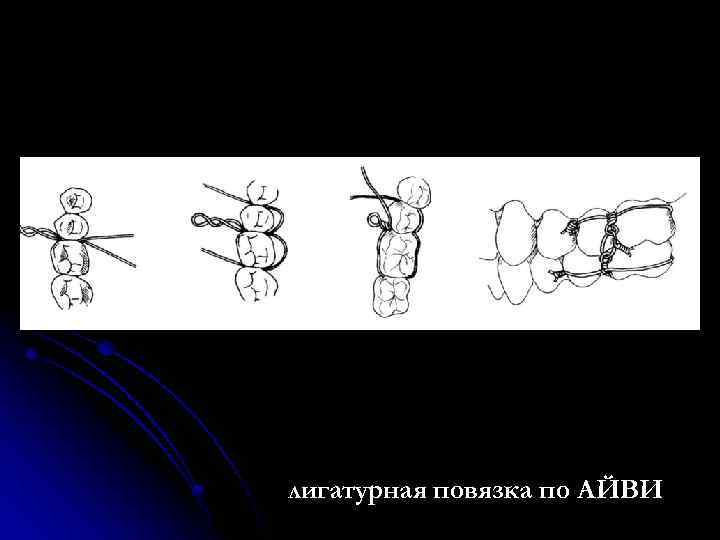 лигатурная повязка по АЙВИ 