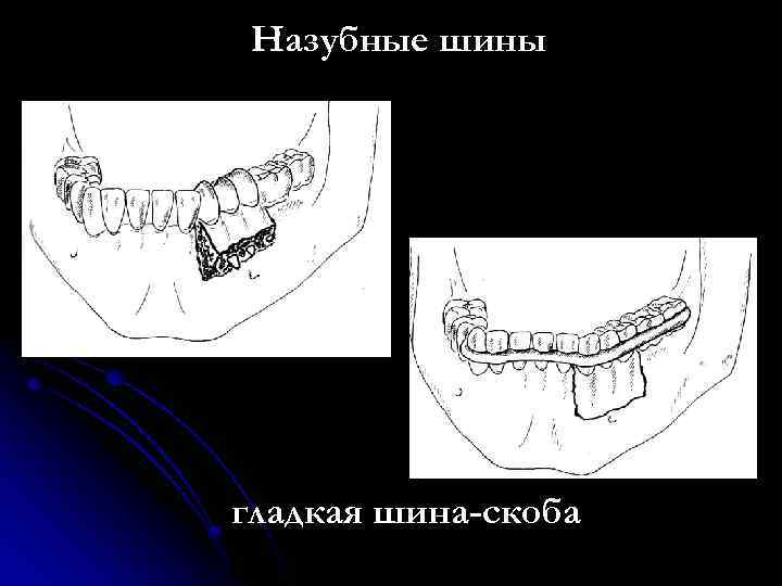 Подвывих челюсти симптомы