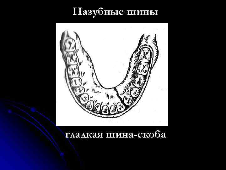 Назубные шины гладкая шина-скоба 