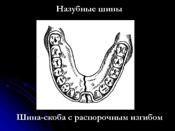 Назубные шины Шина-скоба с распорочным изгибом 