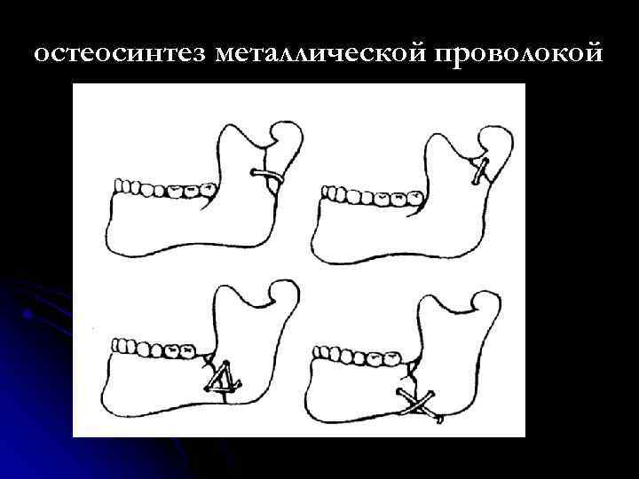 остеосинтез металлической проволокой 