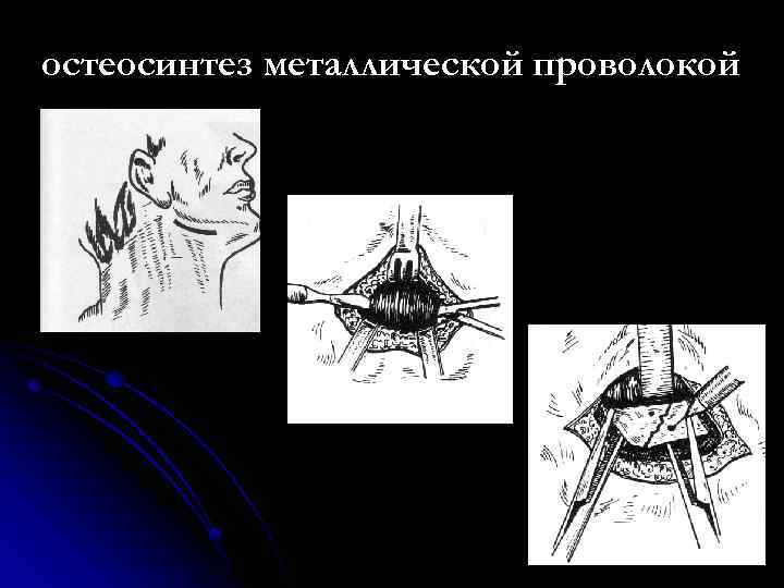 остеосинтез металлической проволокой 