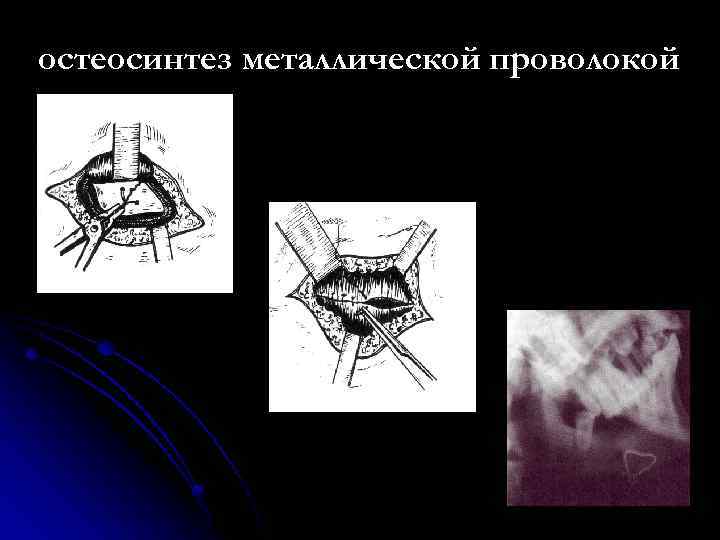 остеосинтез металлической проволокой 