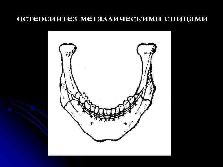 остеосинтез металлическими спицами 