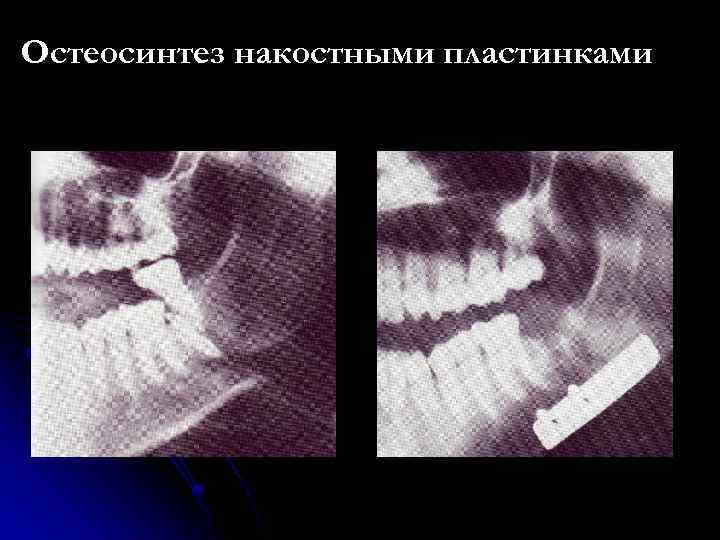 Остеосинтез накостными пластинками 