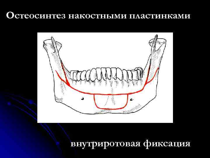 Вывих нижней челюсти карта вызова