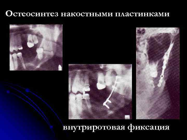 Остеосинтез накостными пластинками внутриротовая фиксация 