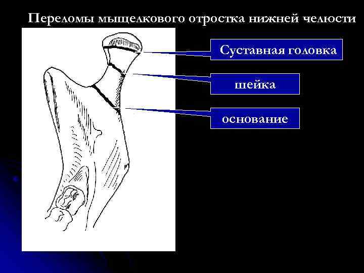 Вывих нижней челюсти карта вызова