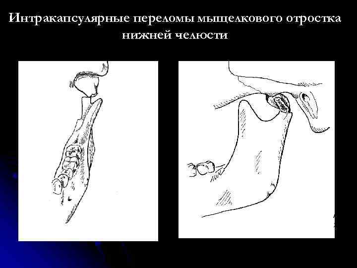 Перелом мыщелкового отростка нижней челюсти. Вывих мыщелкового отростка нижней челюсти. Перелом и вывих нижней челюсти. Подвывих мыщелкового отростка нижней челюсти.